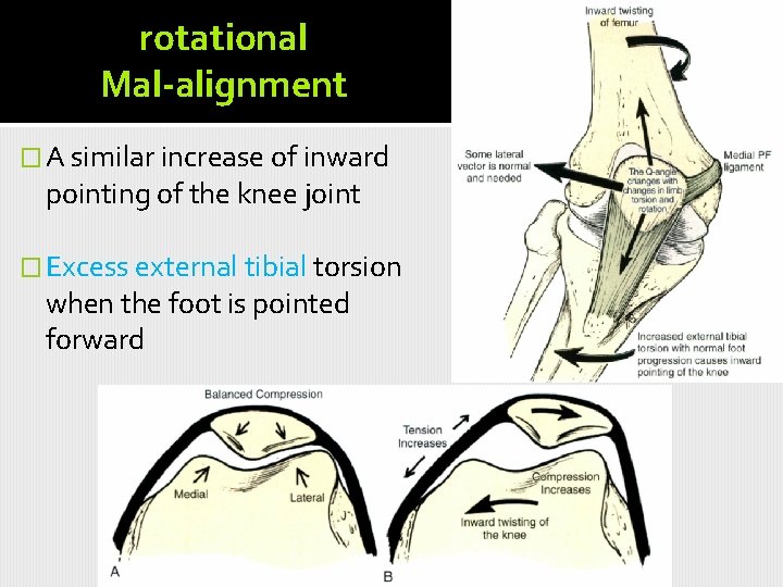 rotational Mal-alignment � A similar increase of inward pointing of the knee joint �