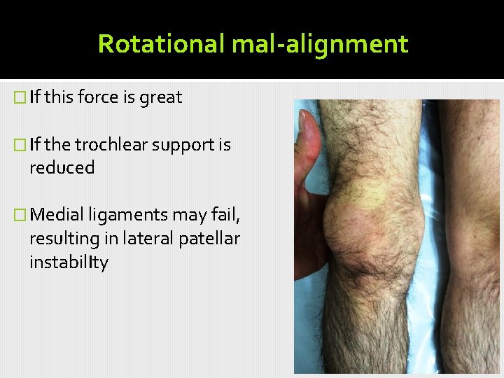 Rotational mal-alignment � If this force is great � If the trochlear support is