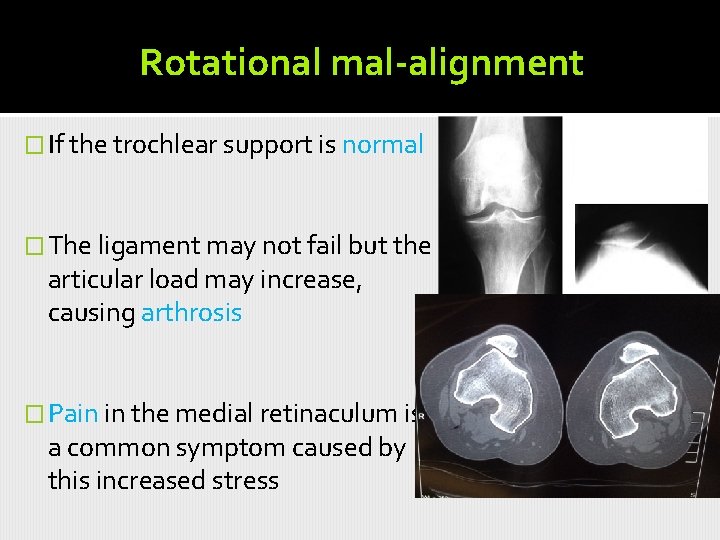 Rotational mal-alignment � If the trochlear support is normal � The ligament may not