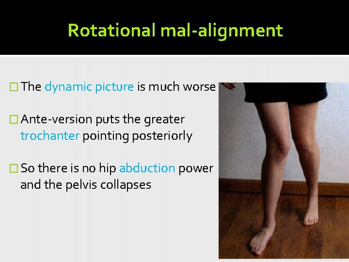 Rotational mal-alignment � The dynamic picture is much worse � Ante-version puts the greater