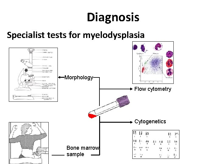 Diagnosis Specialist tests for myelodysplasia Morphology Flow cytometry Cytogenetics Bone marrow sample 