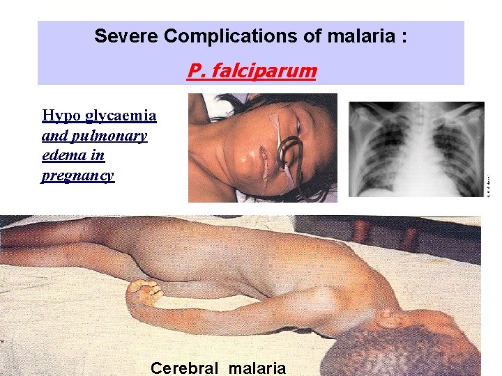 Severe Complications of malaria : P. falciparum Hypo glycaemia and pulmonary edema in pregnancy Severe Complications of malaria : P. falciparum Hypo glycaemia and pulmonary edema in pregnancy