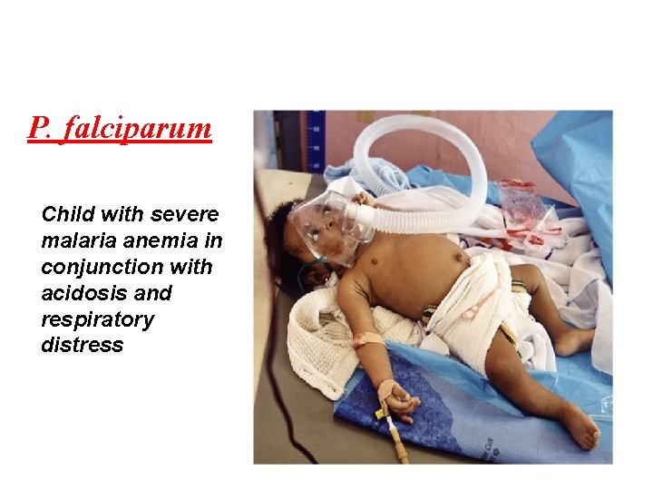 P. falciparum Child with severe malaria anemia in conjunction with acidosis and respiratory distress P. falciparum Child with severe malaria anemia in conjunction with acidosis and respiratory distress