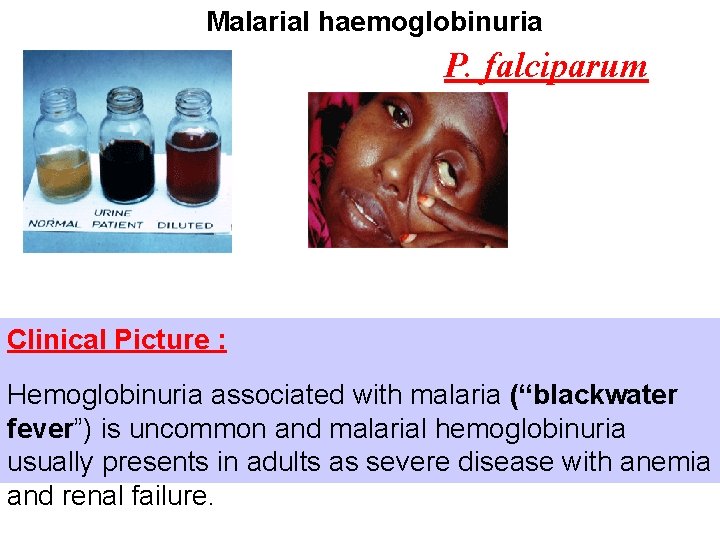 Malarial haemoglobinuria P. falciparum Clinical Picture : Hemoglobinuria associated with malaria (“blackwater fever”) is Malarial haemoglobinuria P. falciparum Clinical Picture : Hemoglobinuria associated with malaria (“blackwater fever”) is