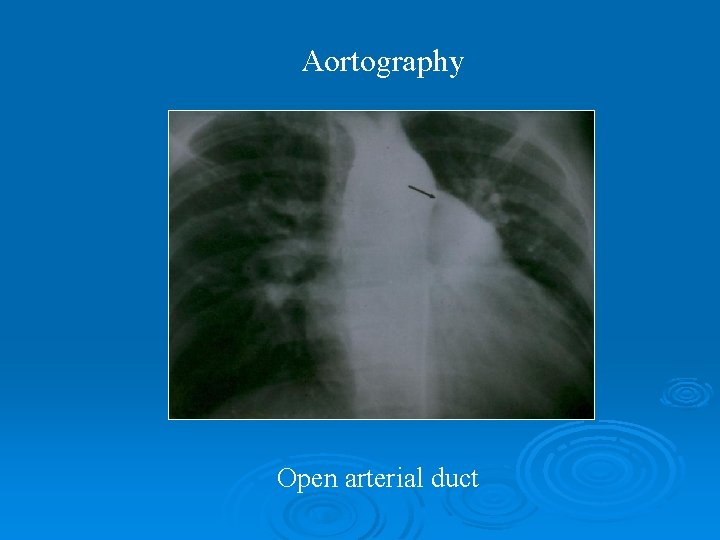 Aortography Open arterial duct 