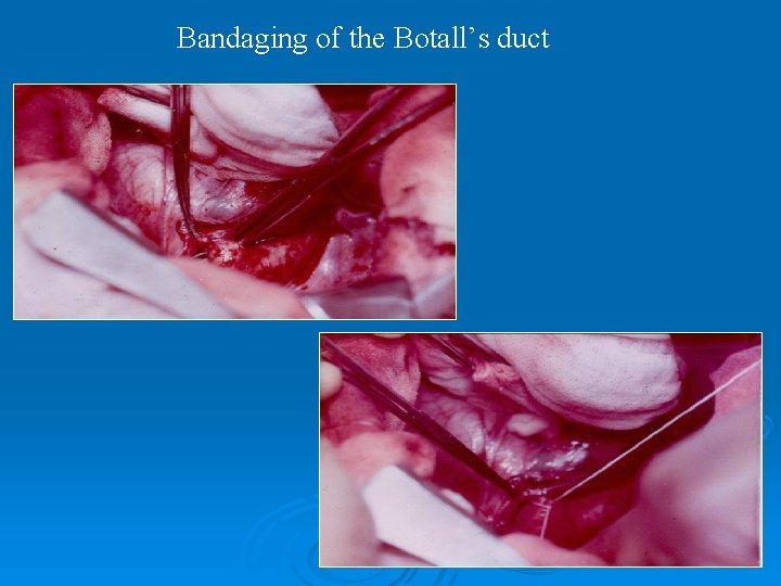 Bandaging of the Botall’s duct 