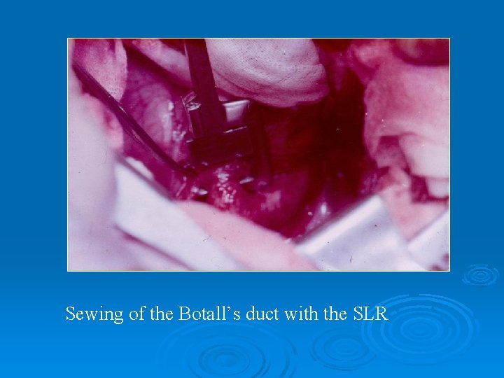 Sewing of the Botall’s duct with the SLR 