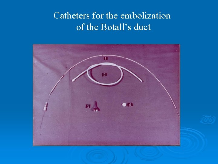 Catheters for the embolization of the Botall’s duct 