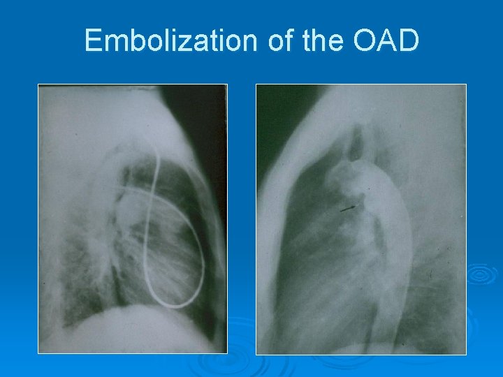Embolization of the OAD 