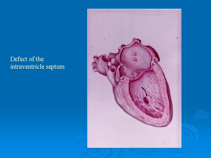 Defect of the intraventricle septum 