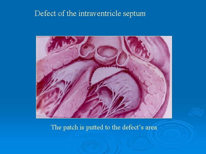 Defect of the intraventricle septum The patch is putted to the defect’s area 