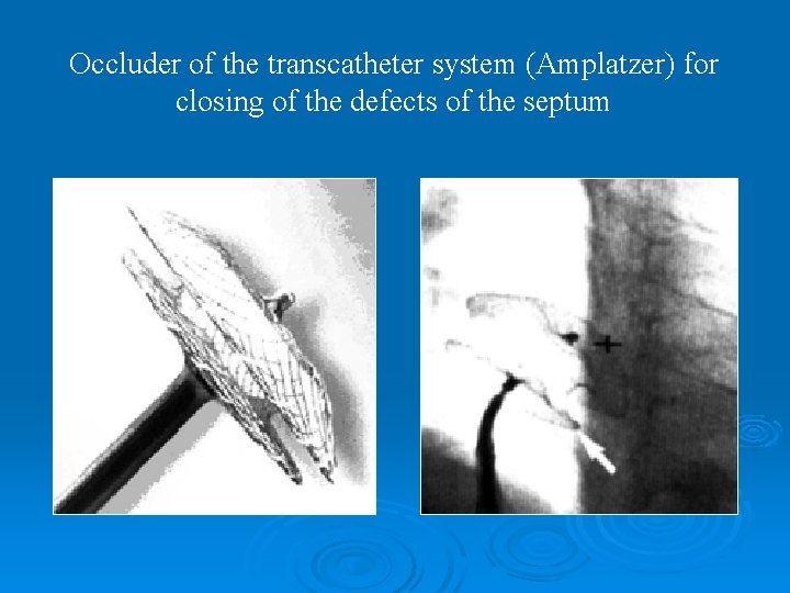 Occluder of the transcatheter system (Amplatzer) for closing of the defects of the septum