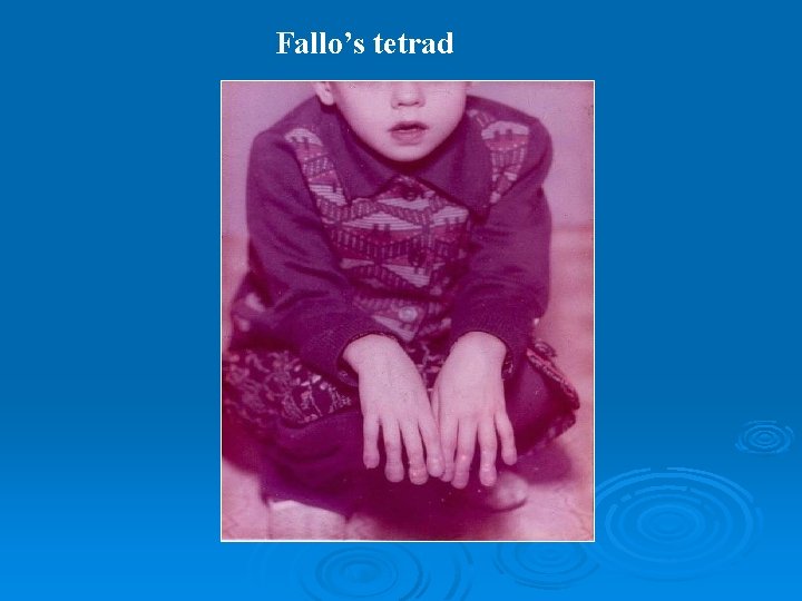 Fallo’s tetrad 
