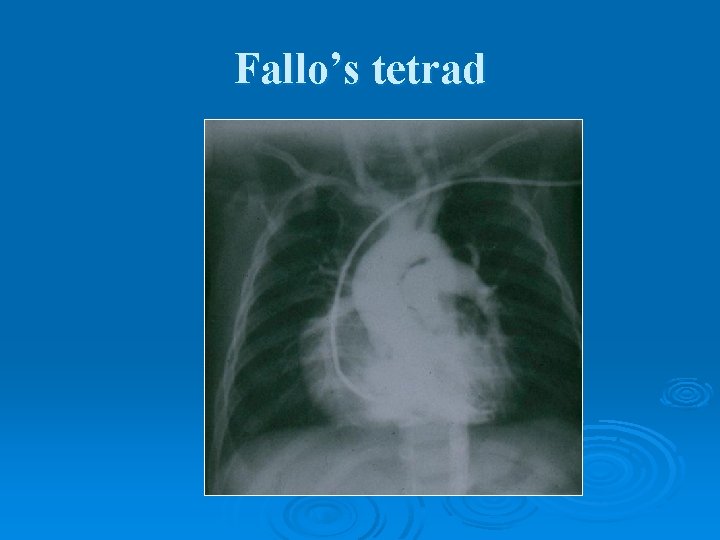 Fallo’s tetrad 