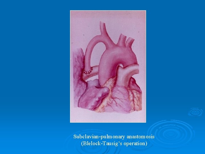 Subclavian-pulmonary anastomosis (Blelock-Tausig’s operation) 