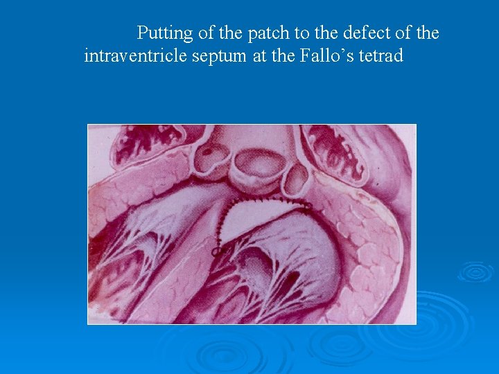 Putting of the patch to the defect of the intraventricle septum at the Fallo’s