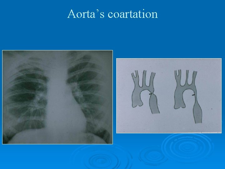 Aorta’s coartation 