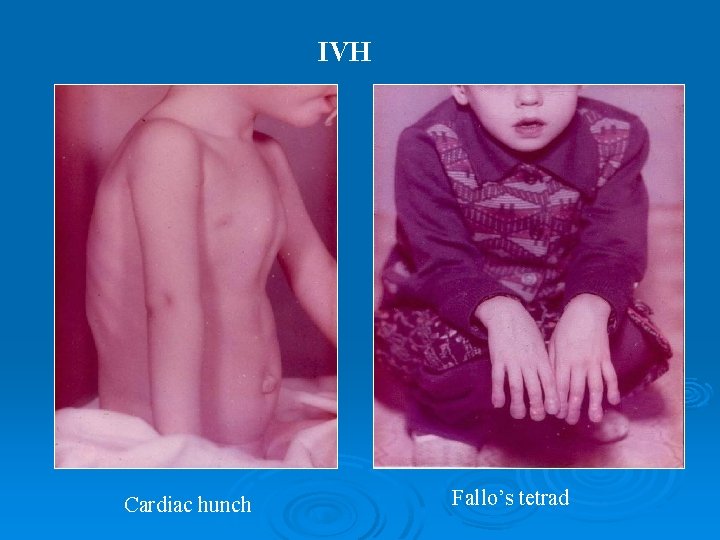 IVH Cardiac hunch Fallo’s tetrad 