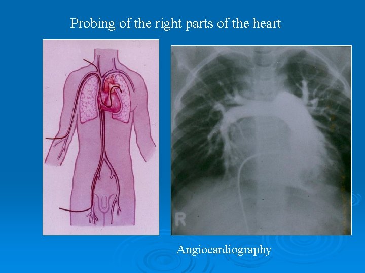 Probing of the right parts of the heart Angiocardiography 
