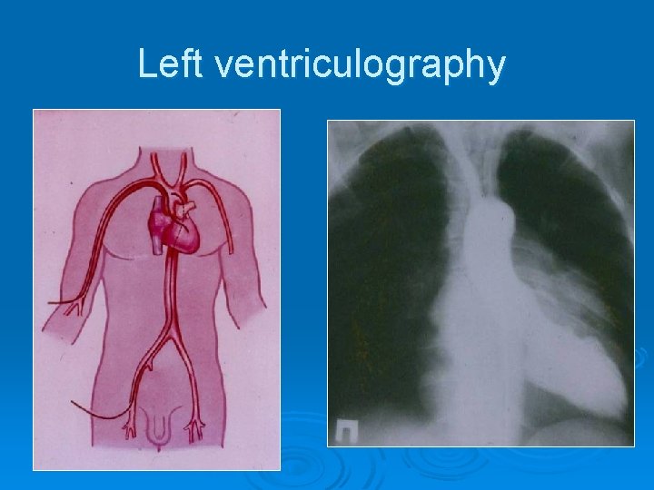 Left ventriculography 