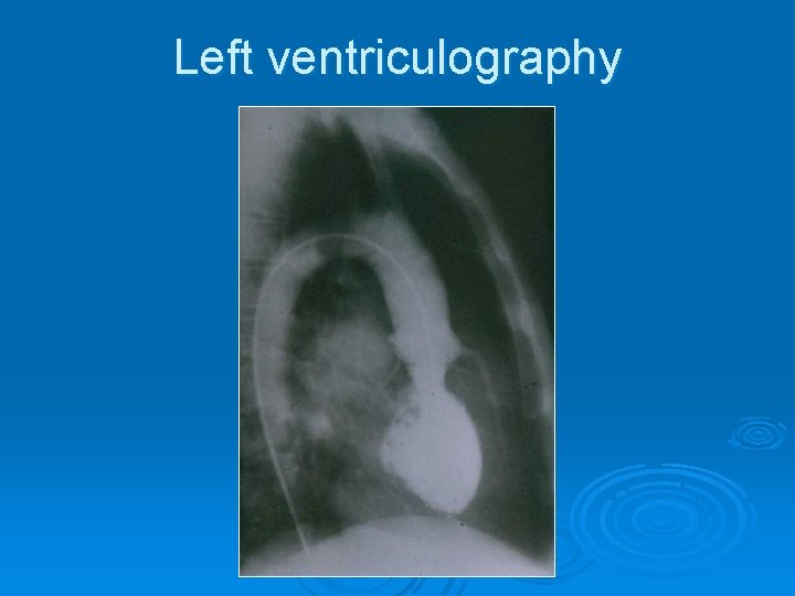 Left ventriculography 