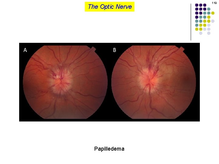 The Optic Nerve Papilledema 119 