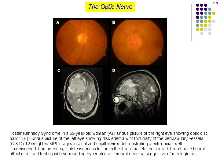 The Optic Nerve Foster Kennedy Syndrome in a 52 -year-old woman (A) Fundus picture