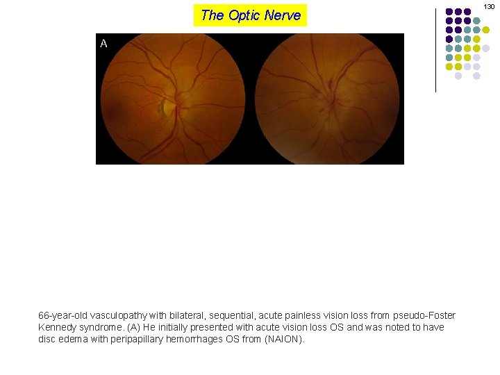 The Optic Nerve 66 -year-old vasculopathy with bilateral, sequential, acute painless vision loss from