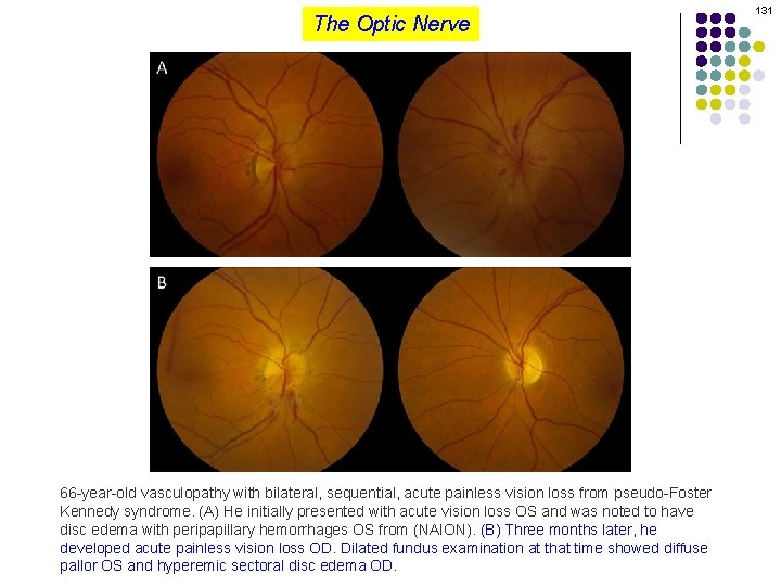 The Optic Nerve 66 -year-old vasculopathy with bilateral, sequential, acute painless vision loss from