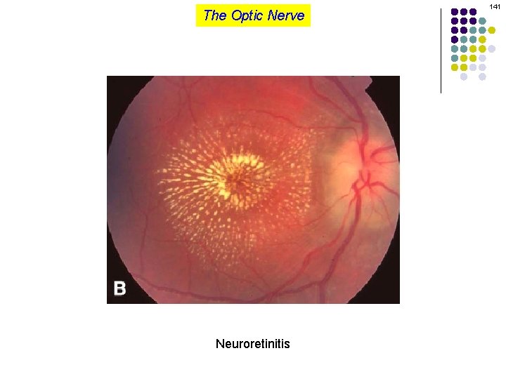 The Optic Nerve Neuroretinitis 141 