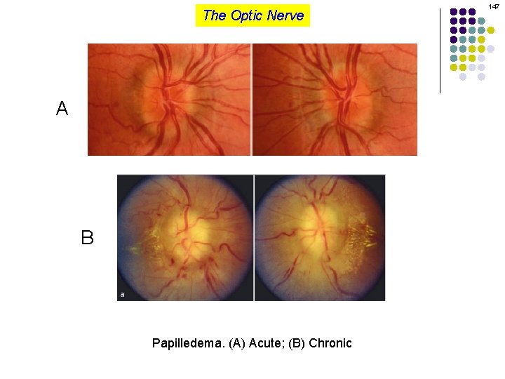 The Optic Nerve A B Papilledema. (A) Acute; (B) Chronic 147 