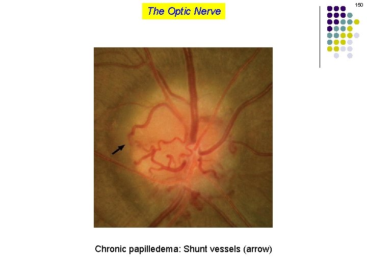 The Optic Nerve Chronic papilledema: Shunt vessels (arrow) 150 