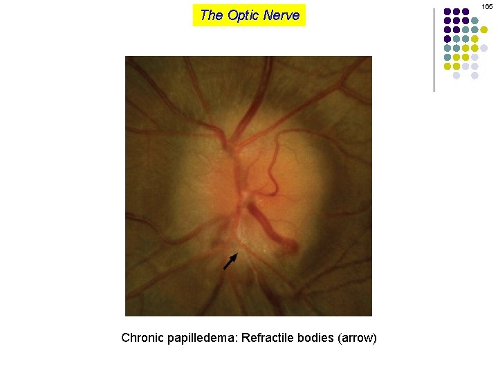 The Optic Nerve Chronic papilledema: Refractile bodies (arrow) 165 