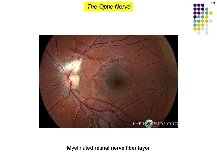 The Optic Nerve Myelinated retinal nerve fiber layer 84 