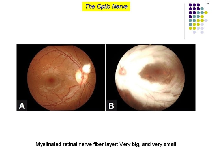 The Optic Nerve Myelinated retinal nerve fiber layer: Very big, and very small 87
