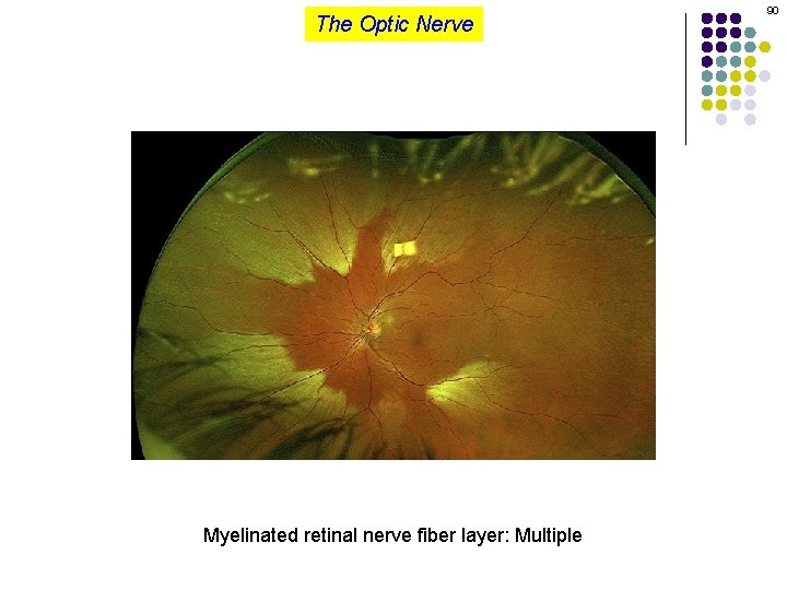 The Optic Nerve Myelinated retinal nerve fiber layer: Multiple 90 