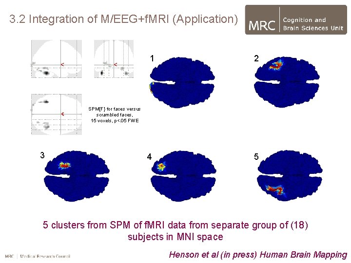 3. 2 Integration of M/EEG+f. MRI (Application) 1 2 4 5 SPM{F} for faces