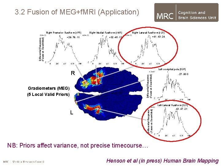 3. 2 Fusion of MEG+f. MRI (Application) R Gradiometers (MEG) (5 Local Valid Priors)
