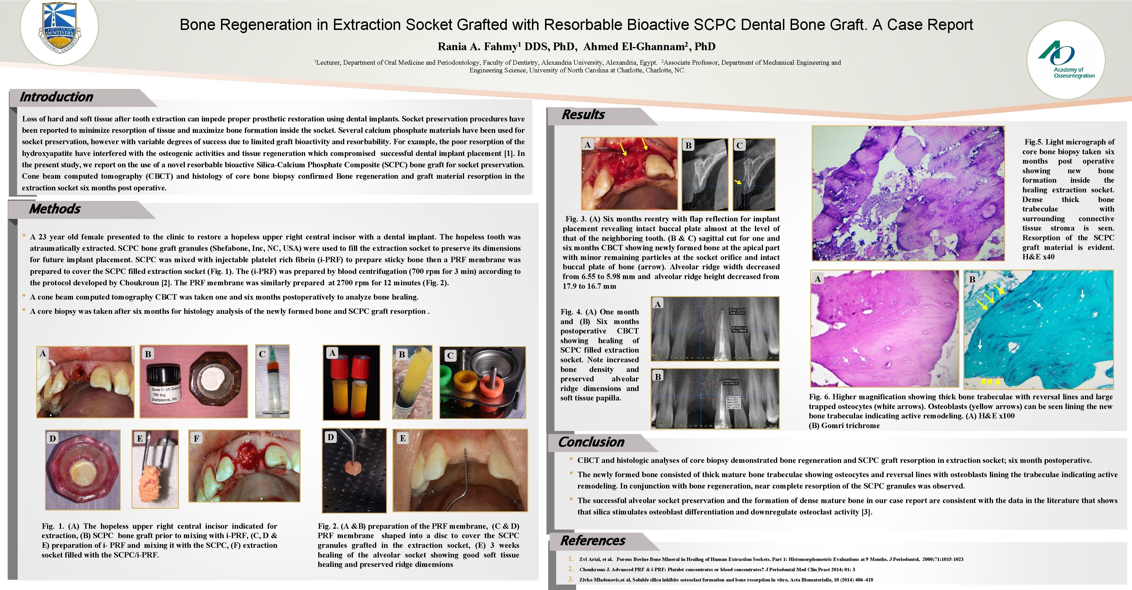 Bone Regeneration in Extraction Socket Grafted with Resorbable Bioactive SCPC Dental Bone Graft. A