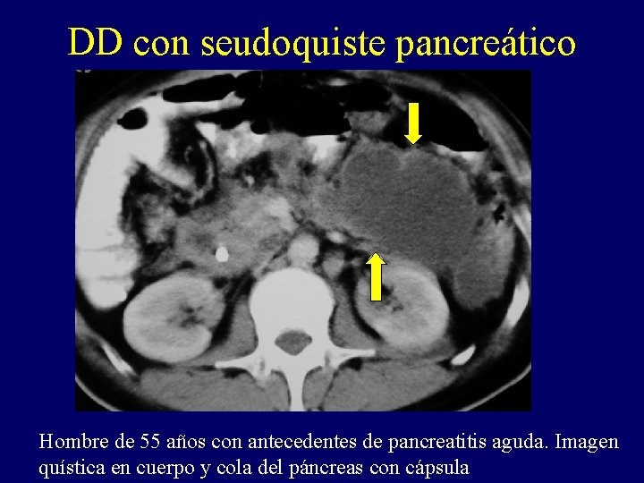 DD con seudoquiste pancreático Hombre de 55 años con antecedentes de pancreatitis aguda. Imagen