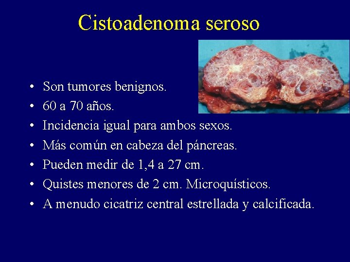 Cistoadenoma seroso • • Son tumores benignos. 60 a 70 años. Incidencia igual para