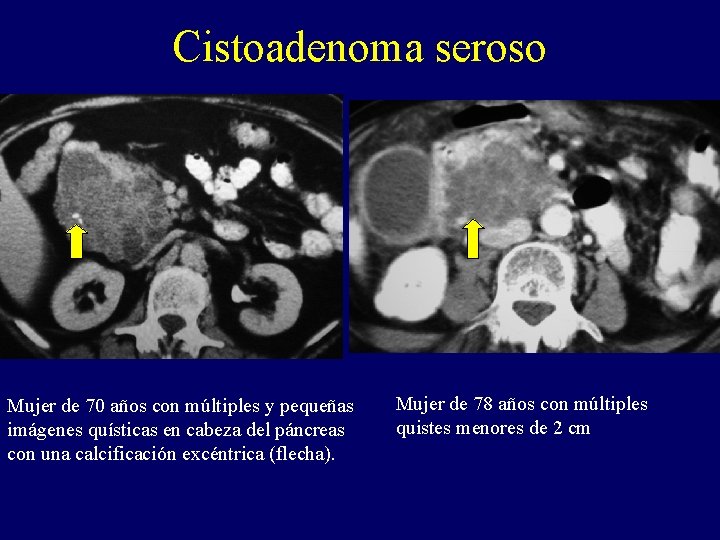 Cistoadenoma seroso Mujer de 70 años con múltiples y pequeñas imágenes quísticas en cabeza Cistoadenoma seroso Mujer de 70 años con múltiples y pequeñas imágenes quísticas en cabeza