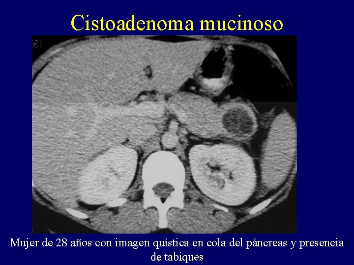 Cistoadenoma mucinoso Mujer de 28 años con imagen quística en cola del páncreas y