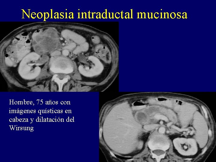 Neoplasia intraductal mucinosa Hombre, 75 años con imágenes quísticas en cabeza y dilatación del