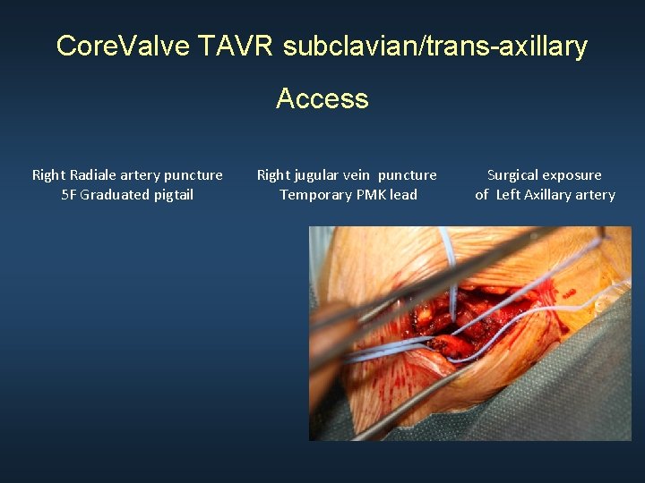 Core. Valve TAVR subclavian/trans-axillary Access Right Radiale artery puncture 5 F Graduated pigtail Right