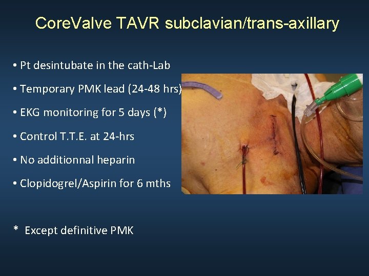 Core. Valve TAVR subclavian/trans-axillary • Pt desintubate in the cath-Lab • Temporary PMK lead