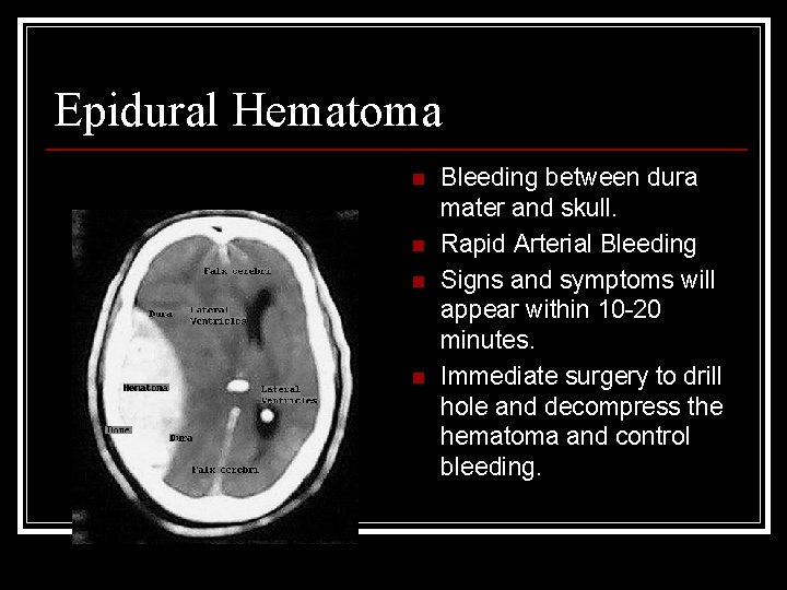 Epidural Hematoma n n Bleeding between dura mater and skull. Rapid Arterial Bleeding Signs