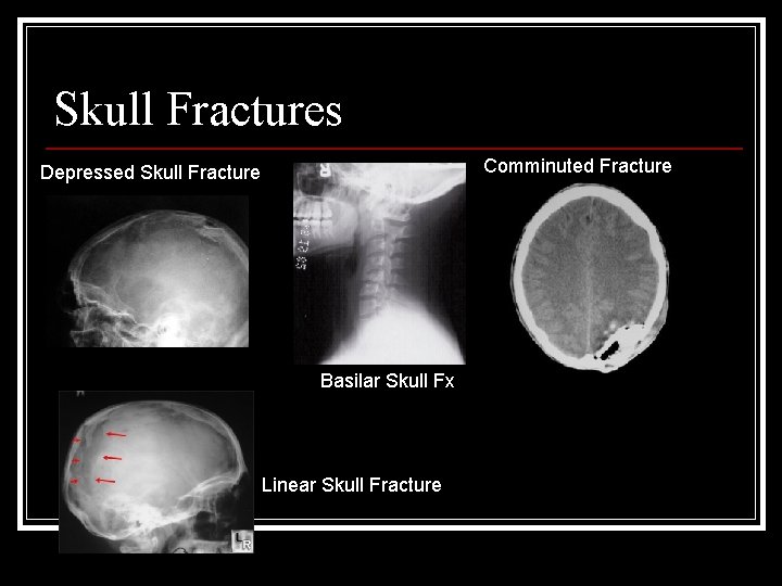 Skull Fractures Comminuted Fracture Depressed Skull Fracture Basilar Skull Fx Linear Skull Fracture 