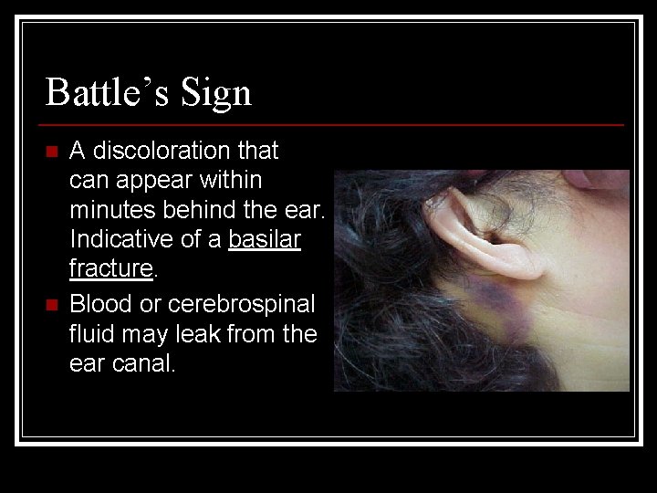 Battle’s Sign n n A discoloration that can appear within minutes behind the ear.