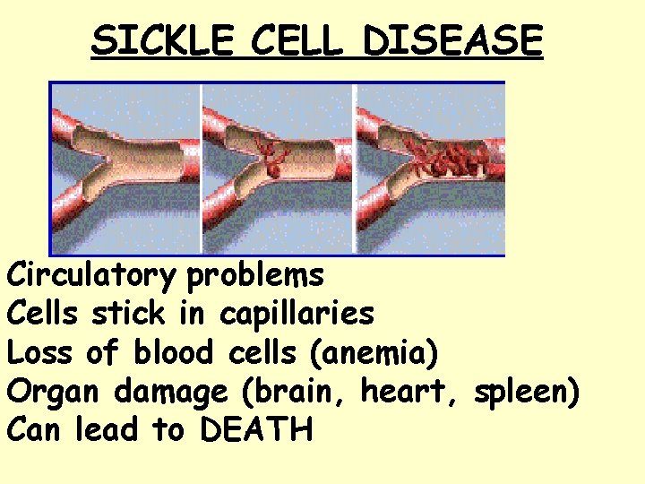 SICKLE CELL DISEASE Circulatory problems Cells stick in capillaries Loss of blood cells (anemia)